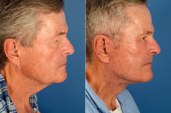 The UpLift™ Lower Face and Neck Lift Before and After Photos in Naples, FL, Patient 16398