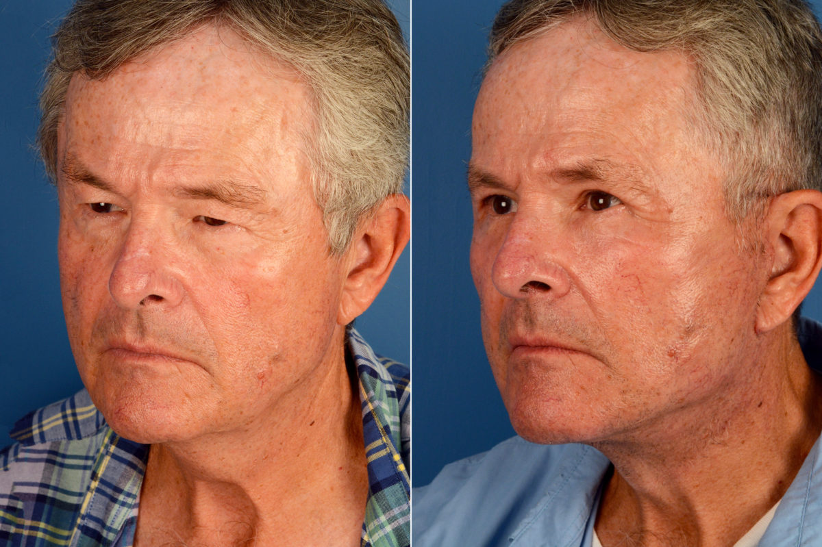 The UpLift™ Lower Face and Neck Lift Before and After Photos in Naples, FL, Patient 16398