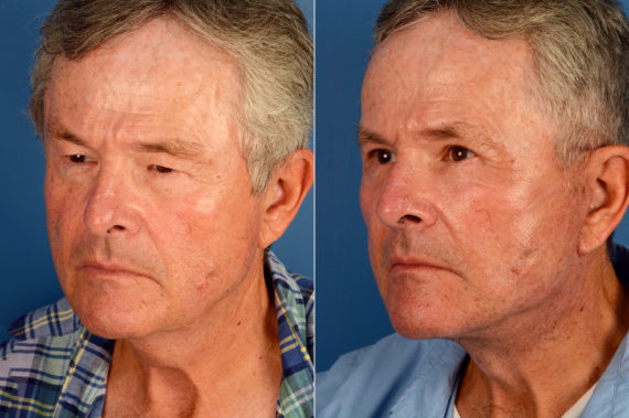 The UpLift™ Lower Face and Neck Lift Before and After Photos in Naples, FL, Patient 16398