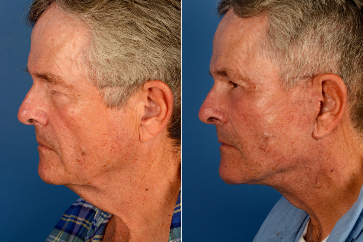 The UpLift™ Lower Face and Neck Lift Before and After Photos in Naples, FL, Patient 16398