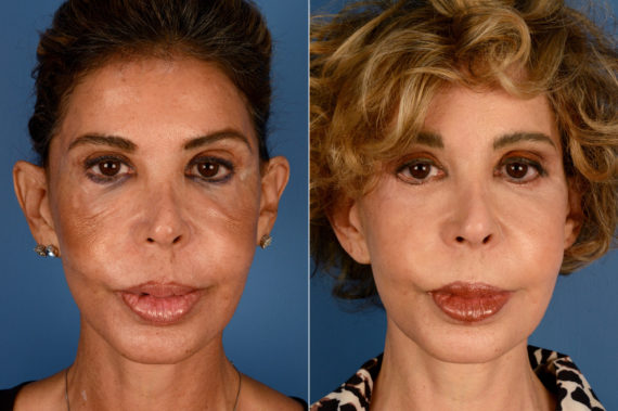 Blepharoplasty Before and After Photos in Naples, FL, Patient 16421