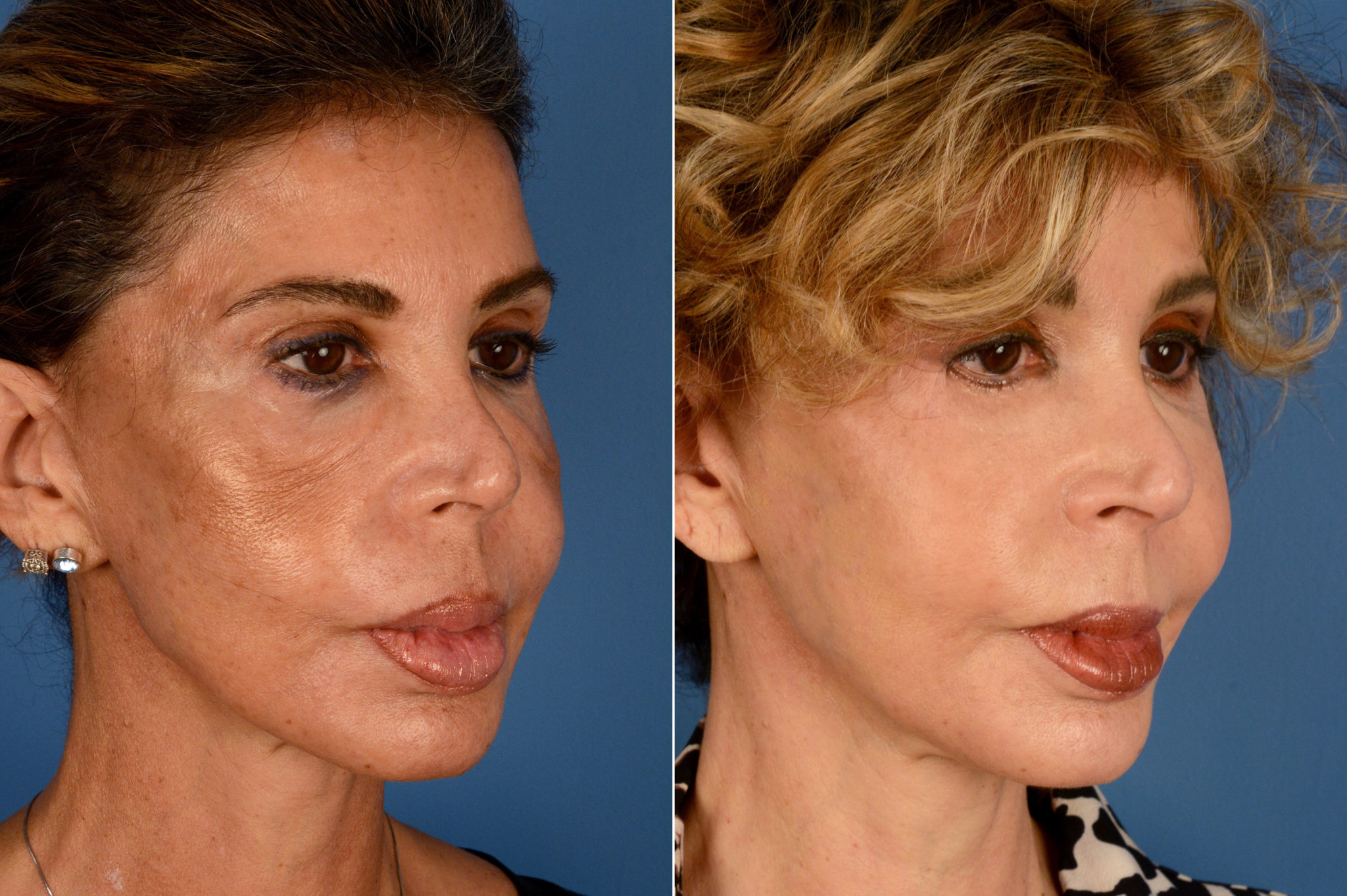 Blepharoplasty Photos Naples, FL Patient 16421