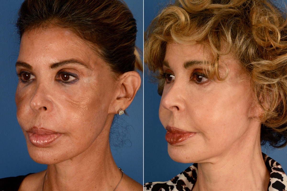 Blepharoplasty Before and After Photos in Naples, FL, Patient 16421