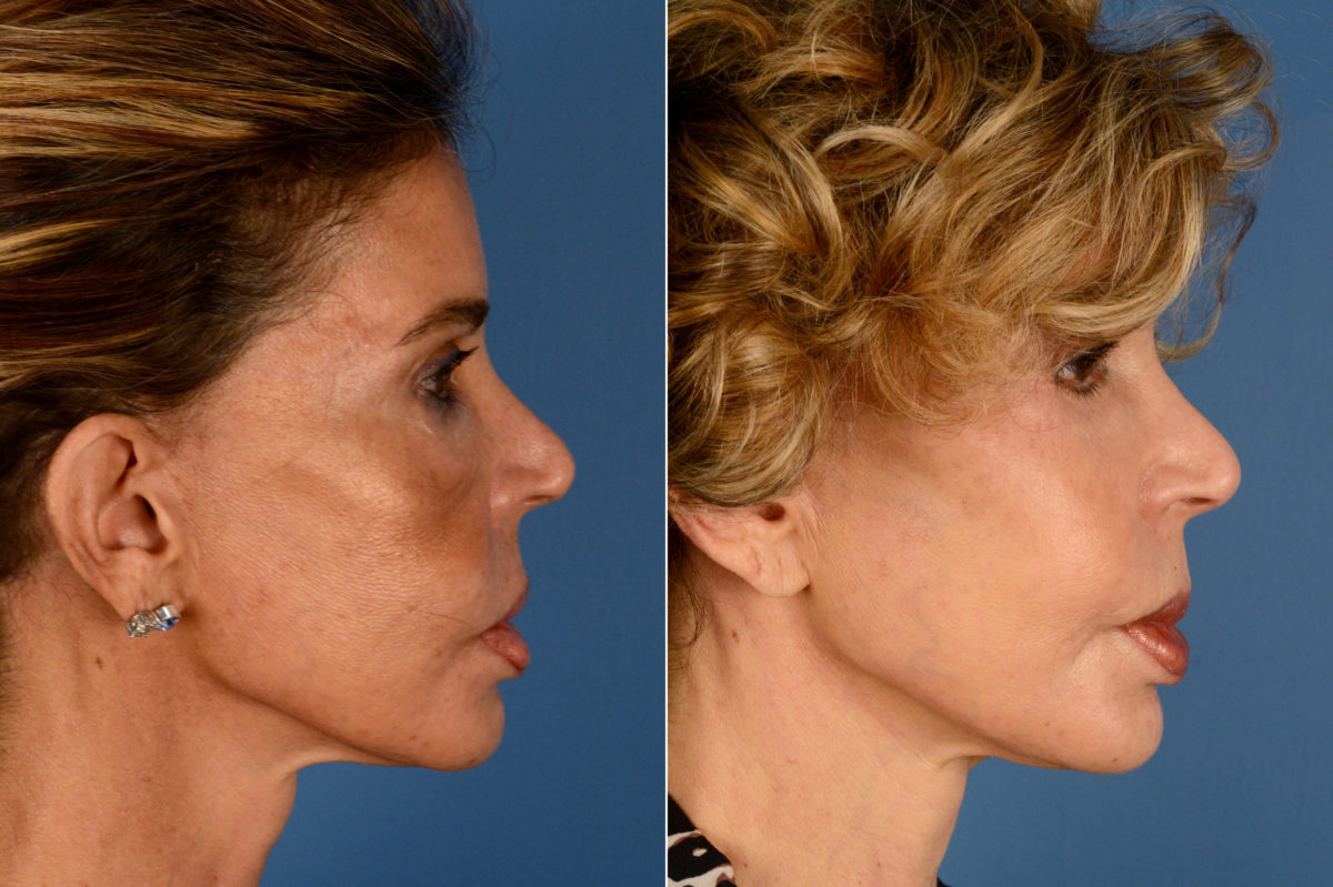 Blepharoplasty Before and After Photos in Naples, FL, Patient 16421