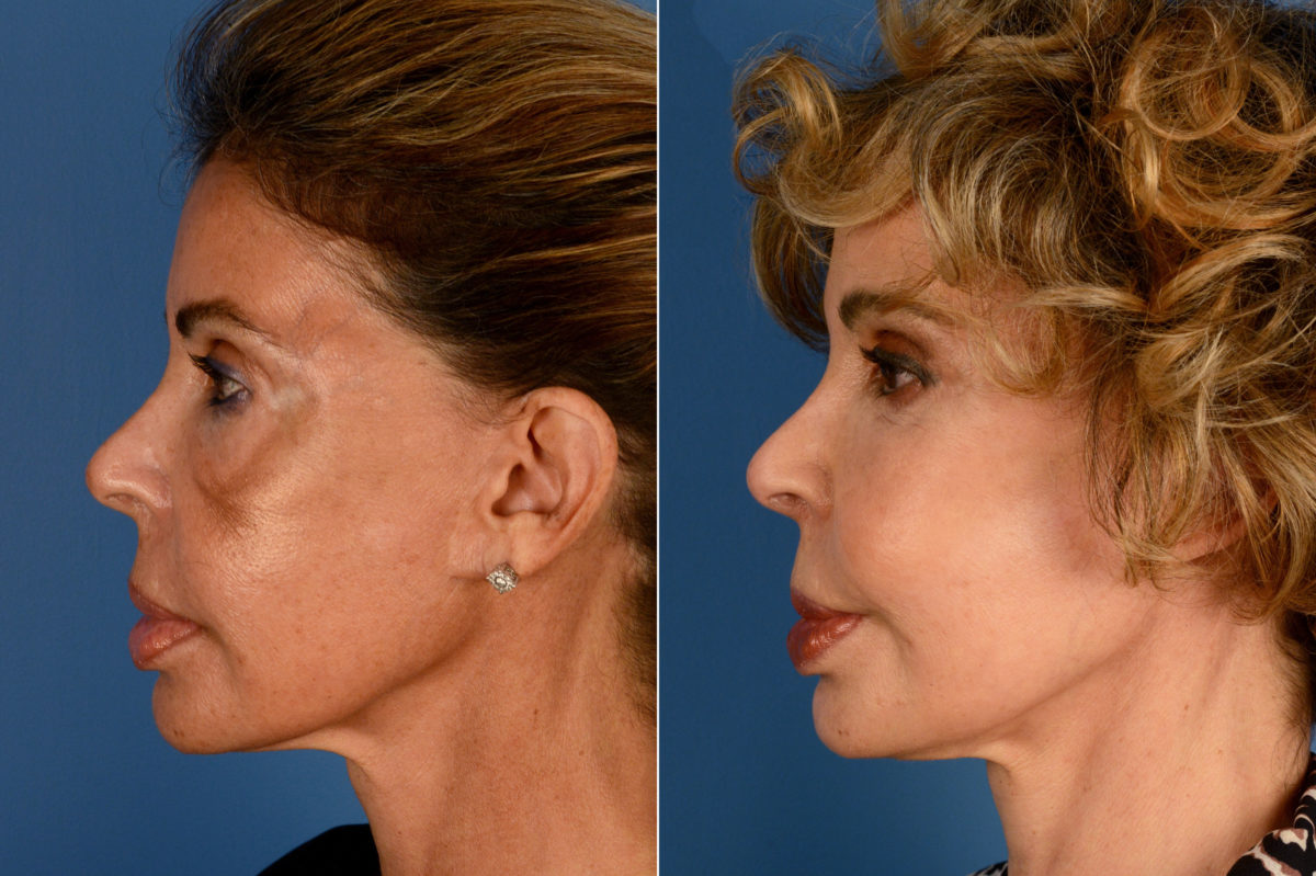 Blepharoplasty Before and After Photos in Naples, FL, Patient 16421