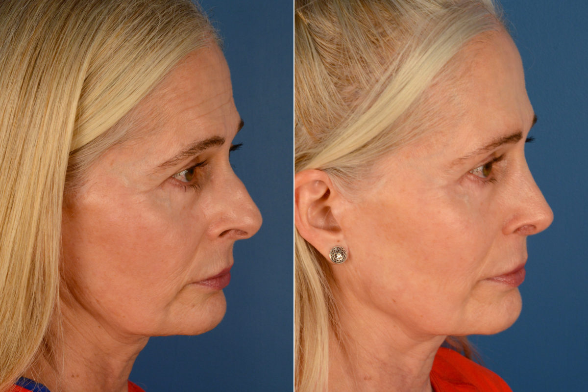 Rhinoplasty Before and After Photos in Naples, FL, Patient 16439