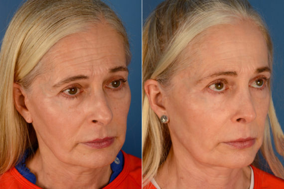 Rhinoplasty Before and After Photos in Naples, FL, Patient 16439