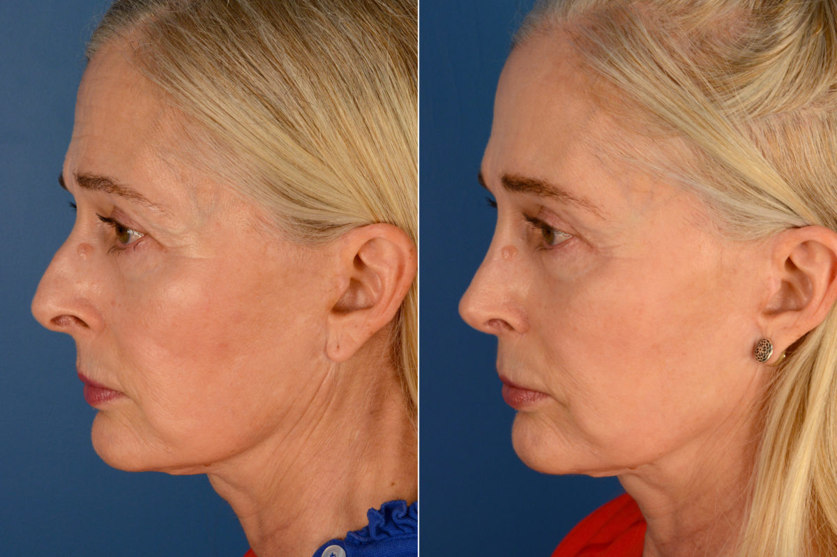 Rhinoplasty Before and After Photos in Naples, FL, Patient 16439