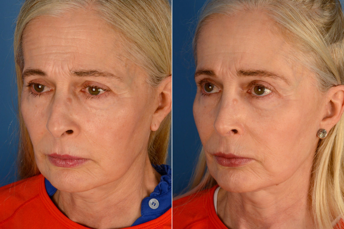 Rhinoplasty Before and After Photos in Naples, FL, Patient 16439
