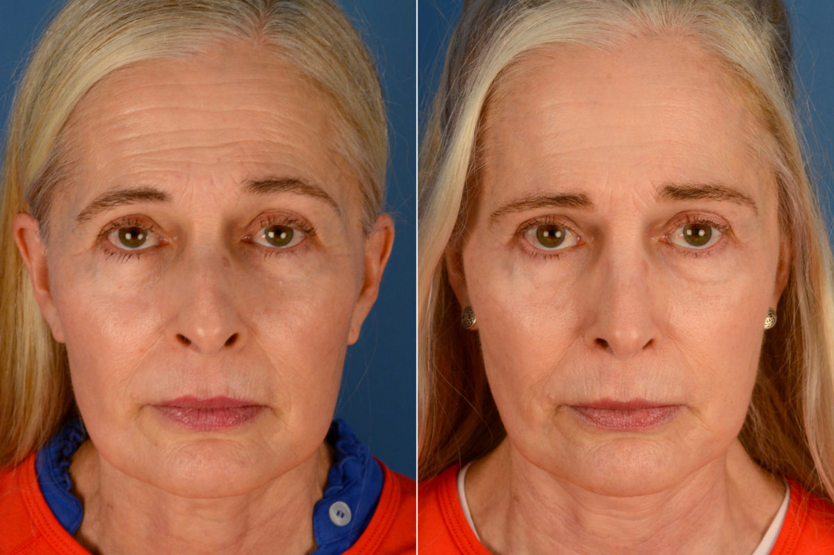 Rhinoplasty Before and After Photos in Naples, FL, Patient 16439