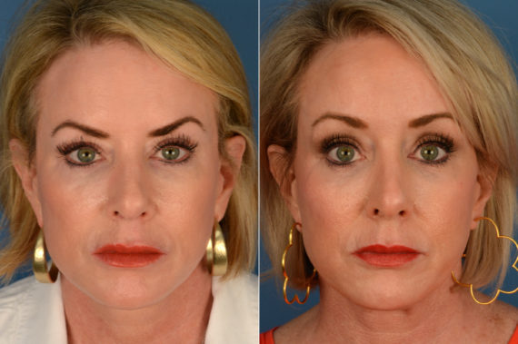 Eyebrow & Forehead Before and After Photos in Naples, FL, Patient 16700