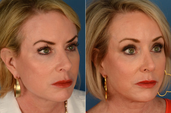 Eyebrow & Forehead Before and After Photos in Naples, FL, Patient 16700