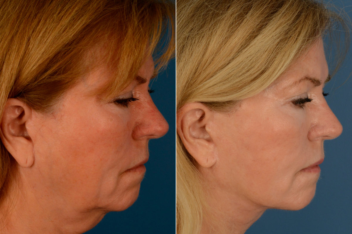The UpLift™ Lower Face and Neck Lift Before and After Photos in Naples, FL, Patient 15434