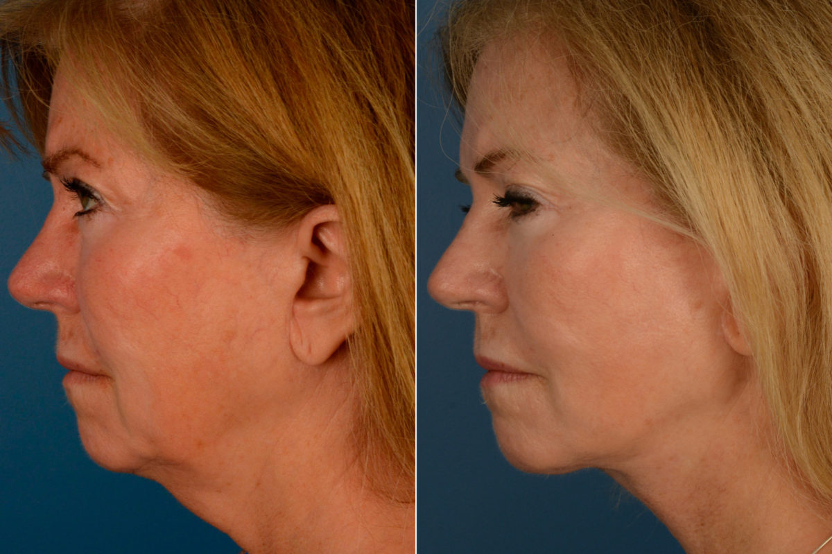 The UpLift™ Lower Face and Neck Lift Before and After Photos in Naples, FL, Patient 15434