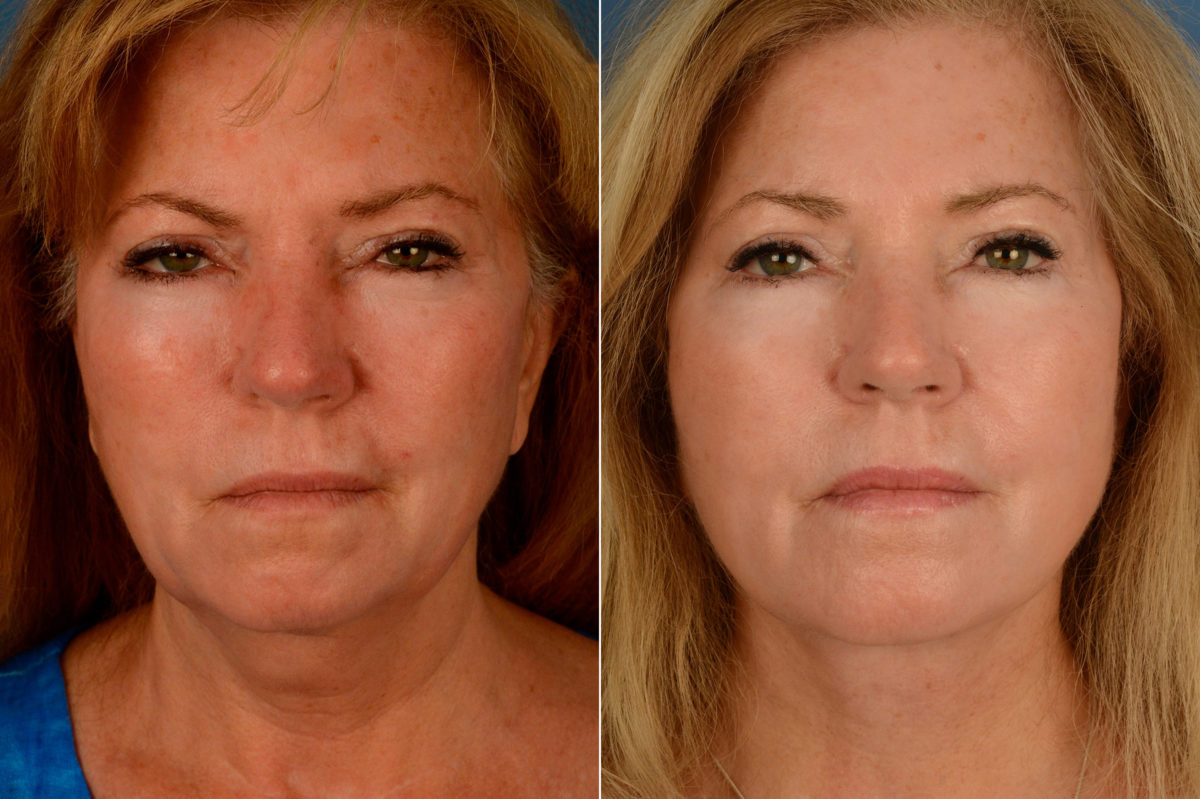 The UpLift™ Lower Face and Neck Lift Before and After Photos in Naples, FL, Patient 15434
