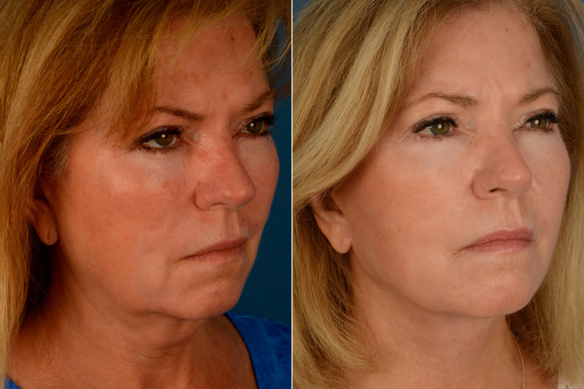 The UpLift™ Lower Face and Neck Lift Before and After Photos in Naples, FL, Patient 15434