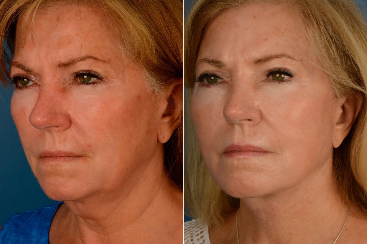 The UpLift™ Lower Face and Neck Lift Before and After Photos in Naples, FL, Patient 15434