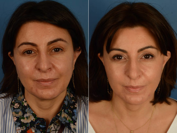 The UpLift™ Lower Face and Neck Lift Before and After Photos in Naples, FL, Patient 16827