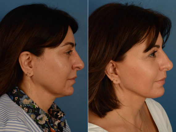 The UpLift™ Lower Face and Neck Lift Before and After Photos in Naples, FL, Patient 16827