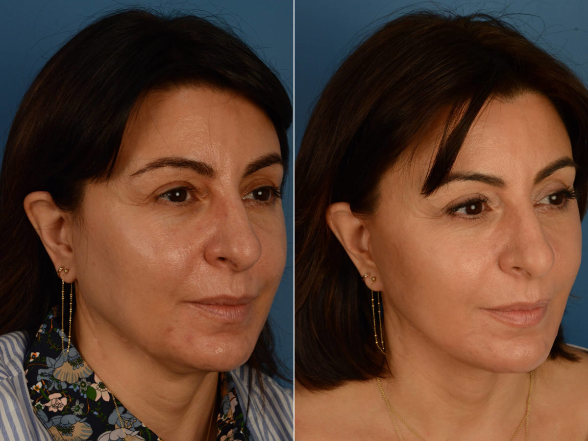 The UpLift™ Lower Face and Neck Lift Before and After Photos in Naples, FL, Patient 16827
