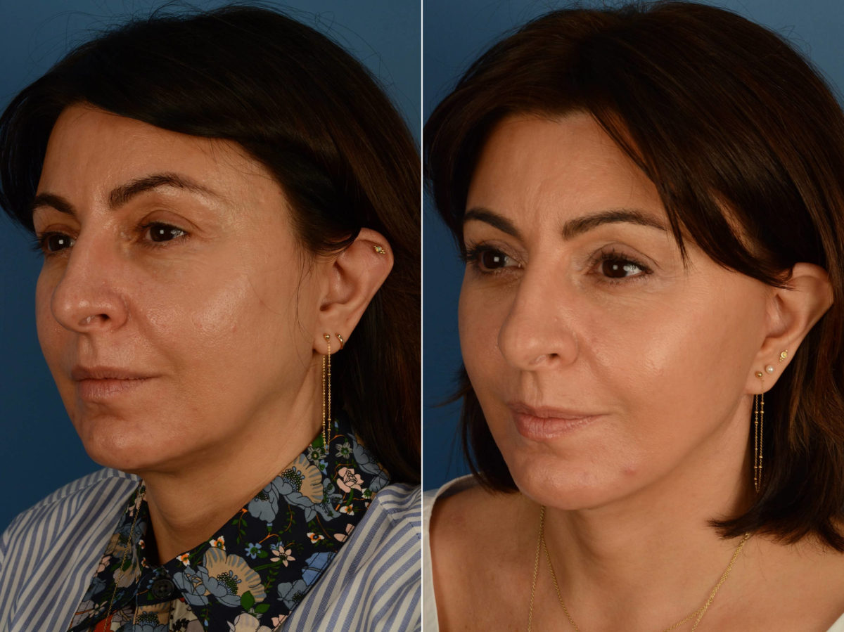 The UpLift™ Lower Face and Neck Lift Before and After Photos in Naples, FL, Patient 16827