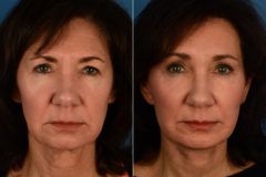 Eyebrow & Forehead Before and After Photos in Naples, FL, Patient 16885