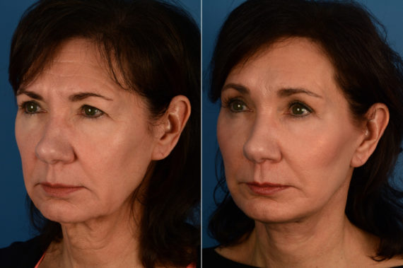 Eyebrow & Forehead Before and After Photos in Naples, FL, Patient 16885