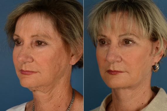The UpLift™ Lower Face and Neck Lift Before and After Photos in Naples, FL, Patient 17021
