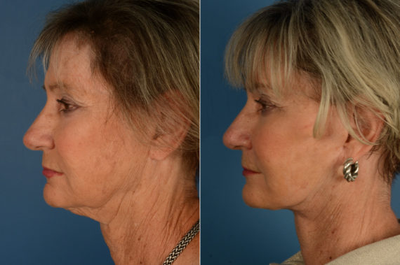 The UpLift™ Lower Face and Neck Lift Before and After Photos in Naples, FL, Patient 17021