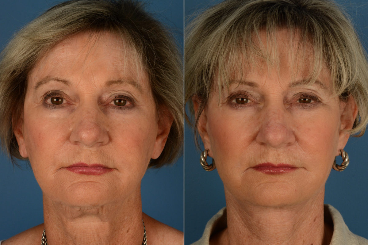 The UpLift™ Lower Face and Neck Lift Before and After Photos in Naples, FL, Patient 17021