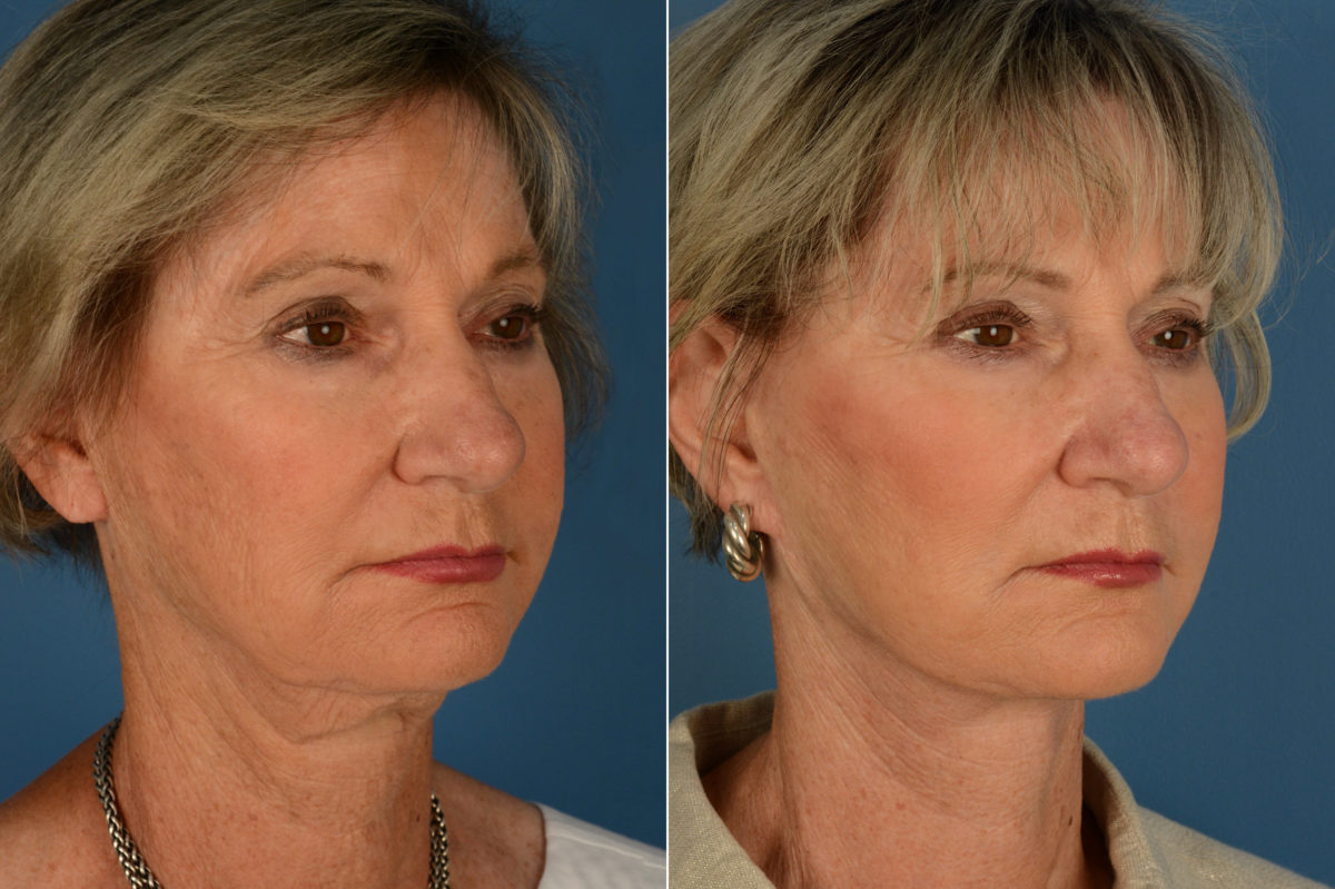 The UpLift™ Lower Face and Neck Lift Before and After Photos in Naples, FL, Patient 17021