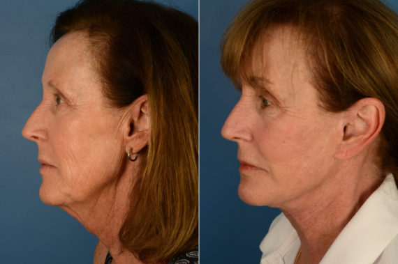 The UpLift™ Lower Face and Neck Lift Before and After Photos in Naples, FL, Patient 17039