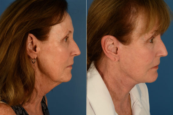 The UpLift™ Lower Face and Neck Lift Before and After Photos in Naples, FL, Patient 17039