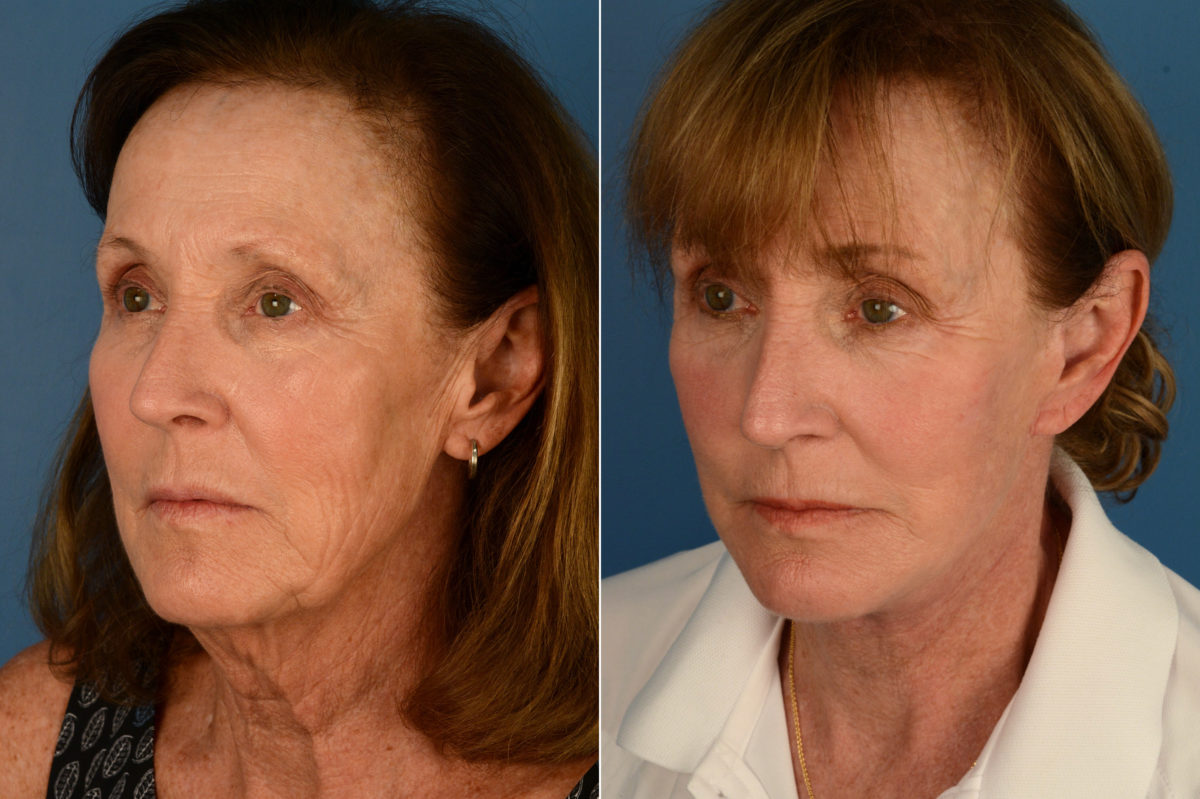 The UpLift™ Lower Face and Neck Lift Before and After Photos in Naples, FL, Patient 17039