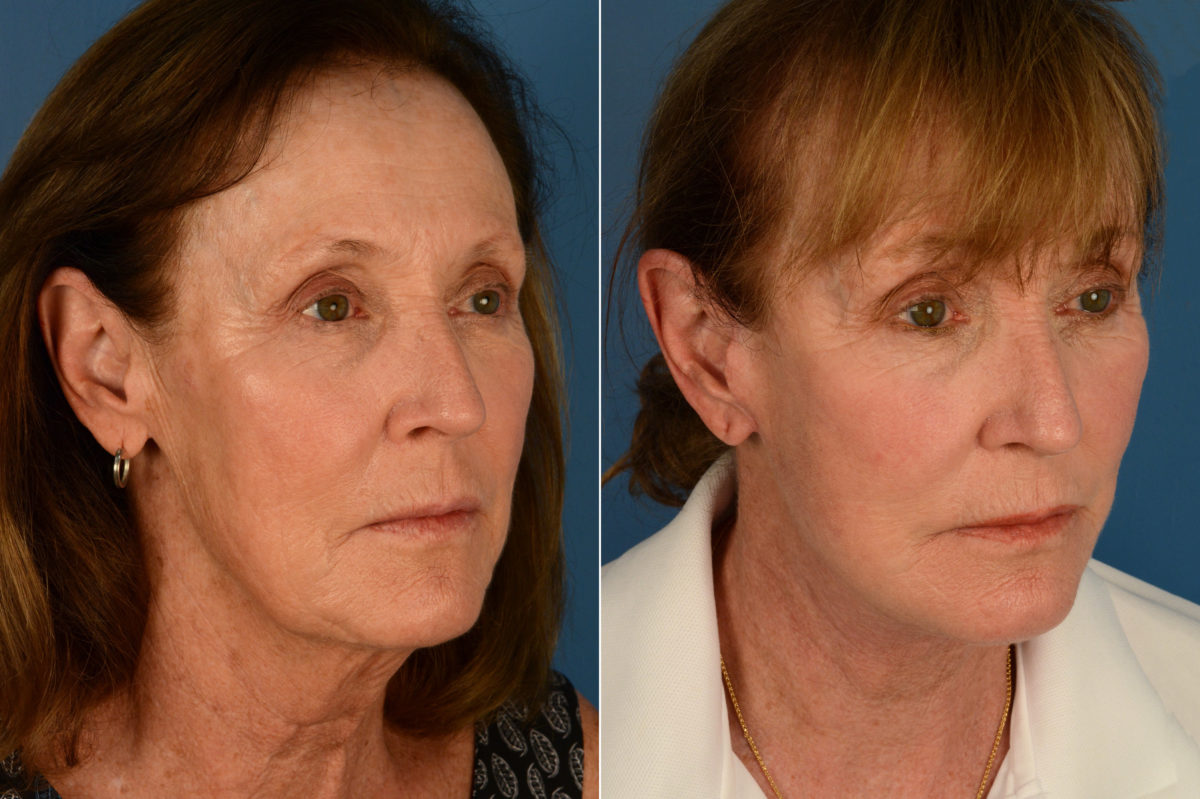 The UpLift™ Lower Face and Neck Lift Before and After Photos in Naples, FL, Patient 17039