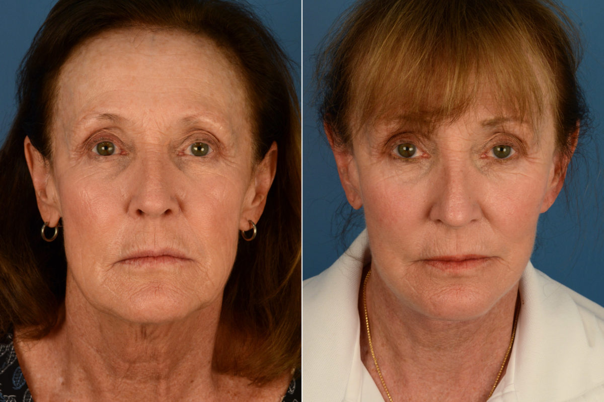 The UpLift™ Lower Face and Neck Lift Before and After Photos in Naples, FL, Patient 17039