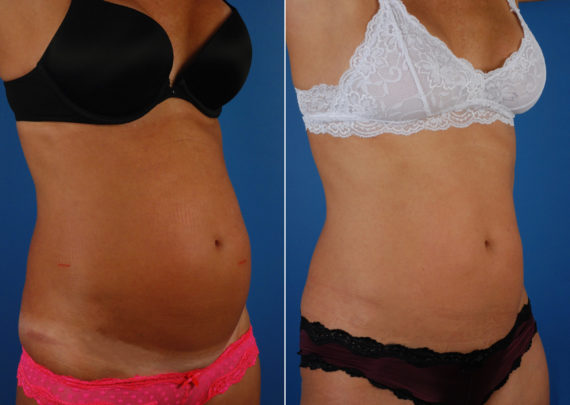 UltraShape Before and After Photos in Naples, FL, Patient 10482