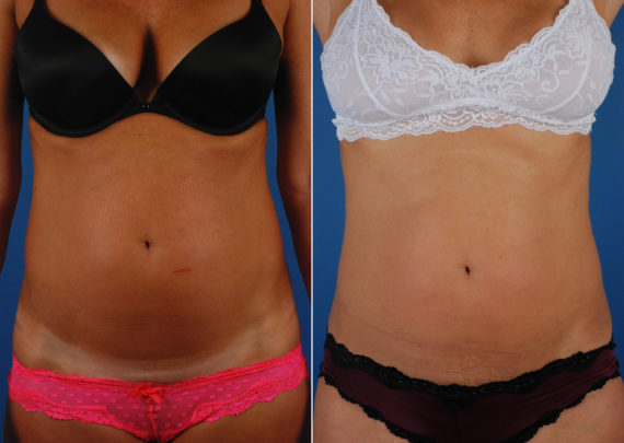 UltraShape Before and After Photos in Naples, FL, Patient 10482