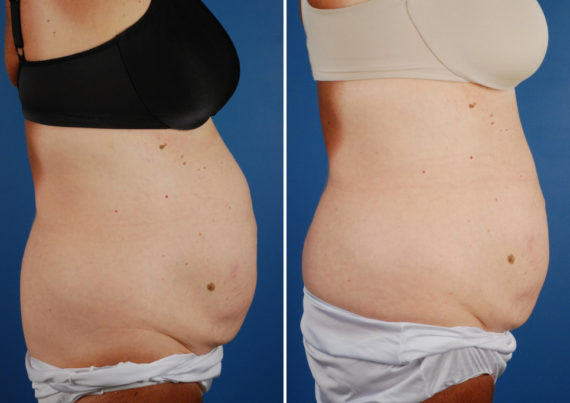 UltraShape Before and After Photos in Naples, FL, Patient 10494