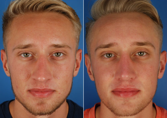 Rhinoplasty Before and After Photos in Naples, FL, Patient 10514