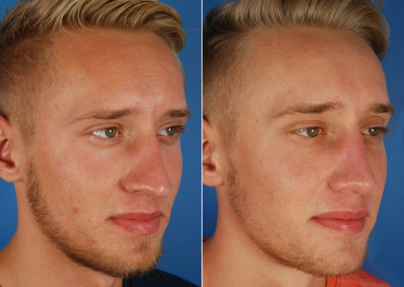 Rhinoplasty Before and After Photos in Naples, FL, Patient 10514