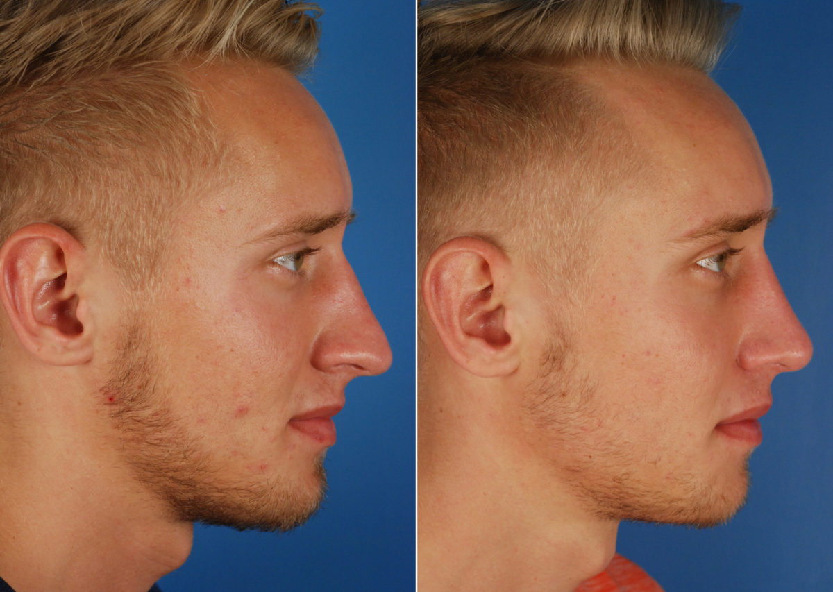 Rhinoplasty Before and After Photos in Naples, FL, Patient 10514