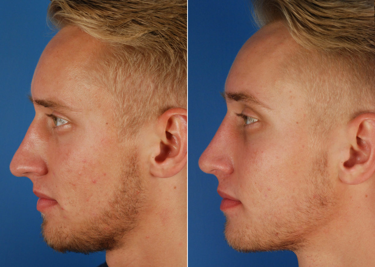 Rhinoplasty Before and After Photos in Naples, FL, Patient 10514