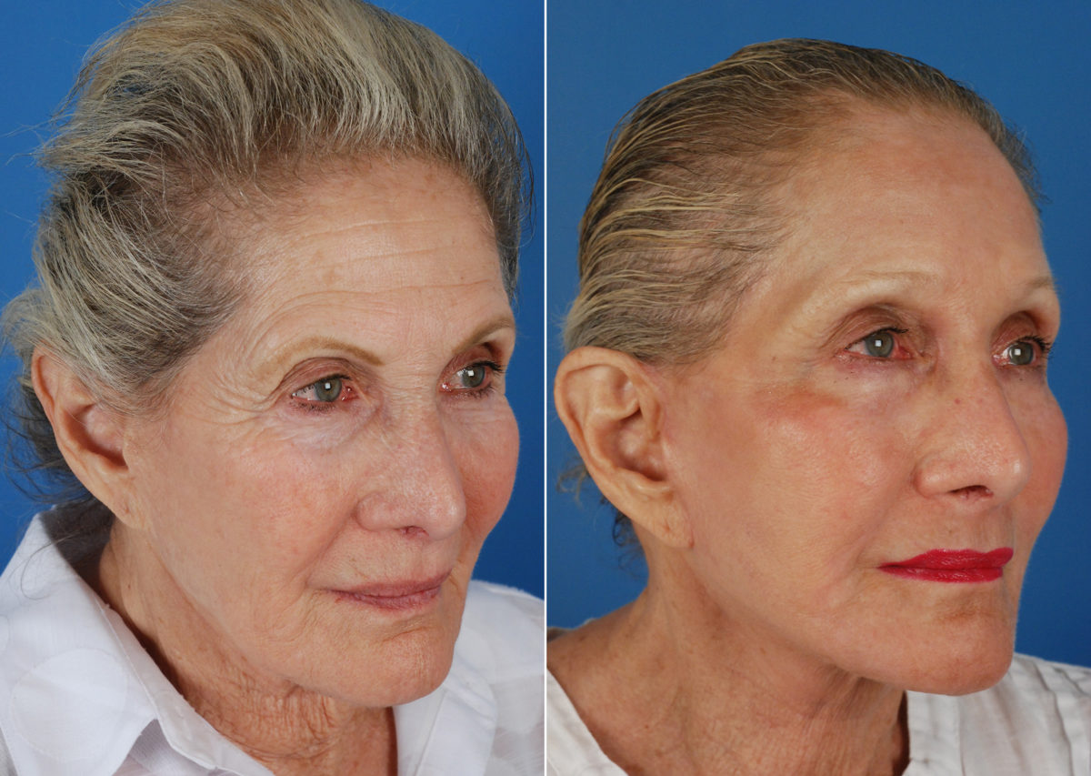 Endoscopic Facelift Before and After Photos in Naples, FL, Patient 10531