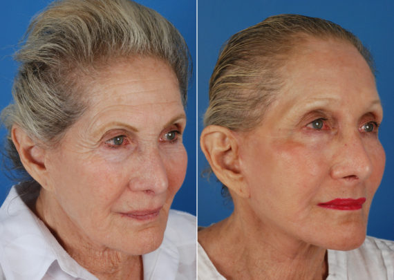 Endoscopic Facelift Before and After Photos in Naples, FL, Patient 10531
