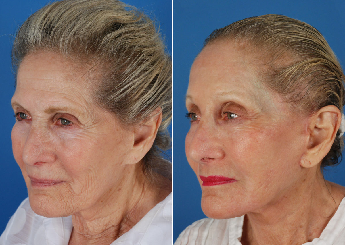 Endoscopic Facelift Before and After Photos in Naples, FL, Patient 10531