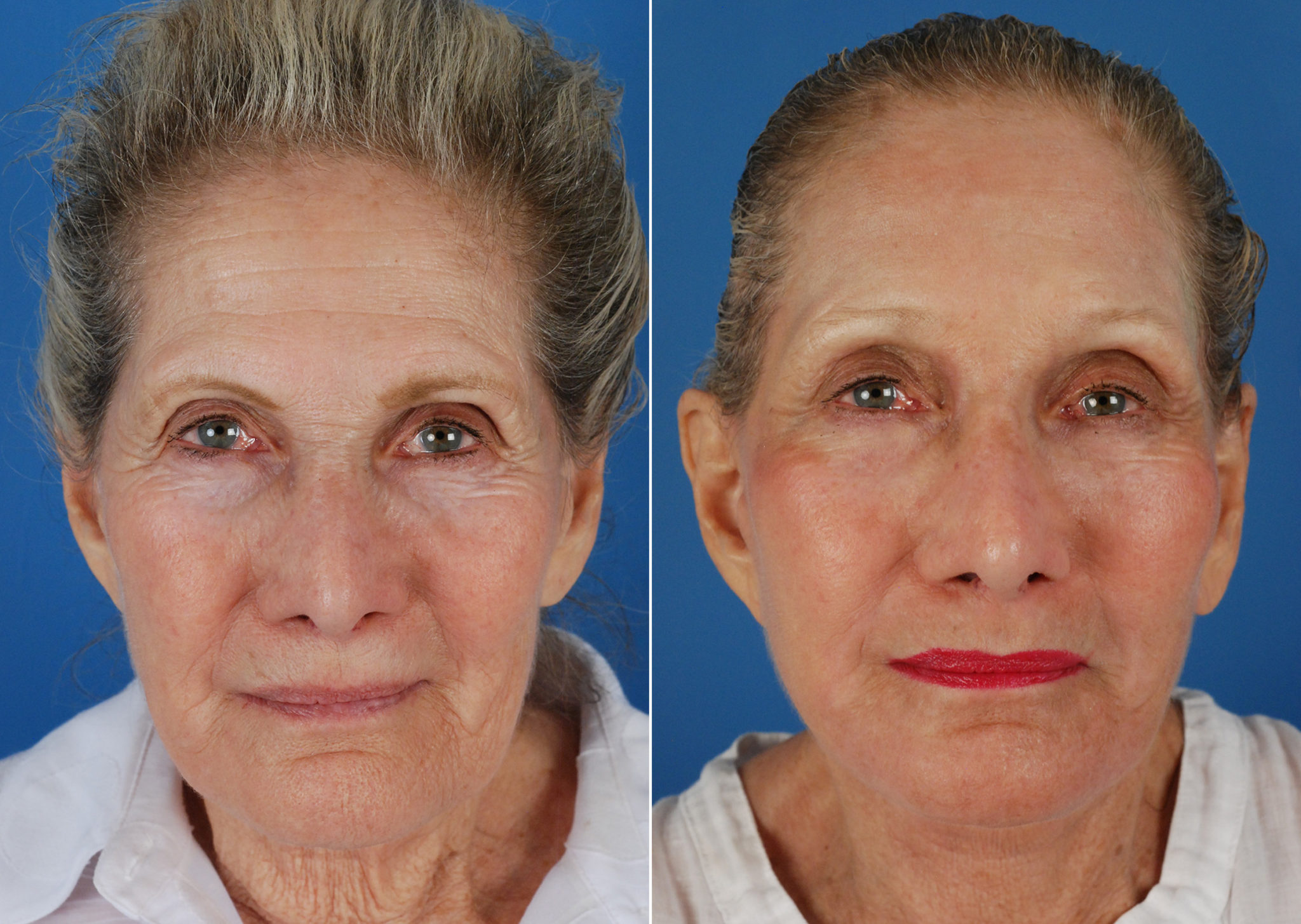 Endoscopic Facelift Photos Naples, FL Patient 10531