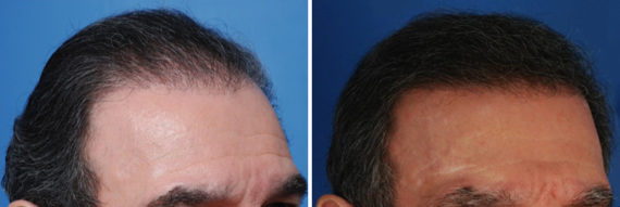 Hair Replacement Before and After Photos in Naples, FL, Patient 10550