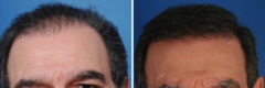 Hair Replacement Before and After Photos in Naples, FL, Patient 10550