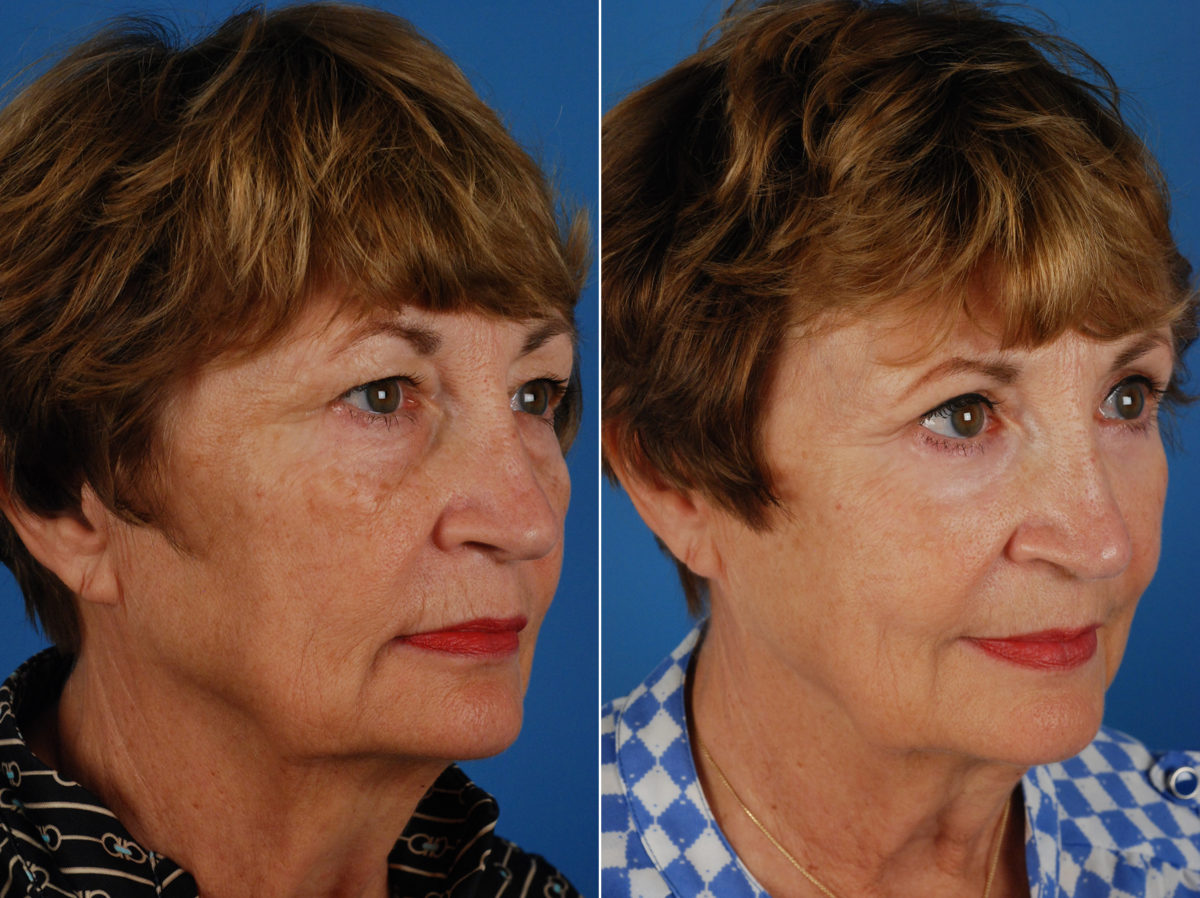 Blepharoplasty Before and After Photos in Naples, FL, Patient 10623